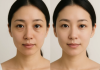 PRP under eyes London: Dark circles and hollows guide prp under eyes cost